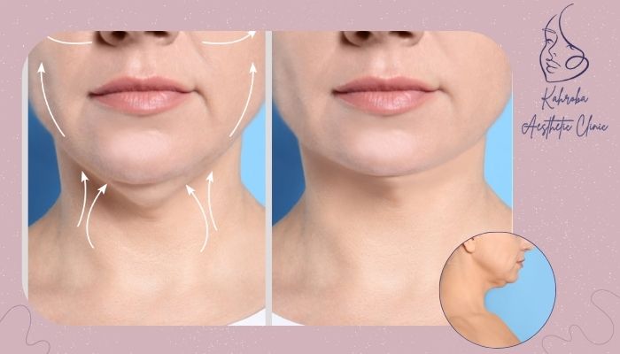 آیا نتایج ساکشن غبغب دائمی هستند؟ آیا نتایج ساکشن غبغب دائمی هستند؟