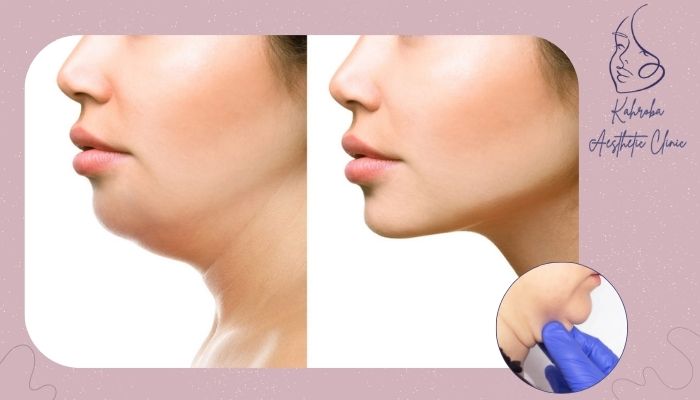 آیا جراحی زیبایی غبغب نیاز به تکرار دارد؟