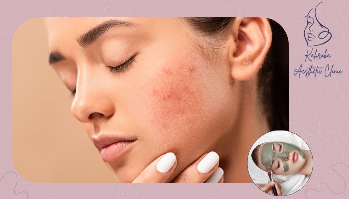 فواید فیشیال صورت برای پوستهای چرب و مستعد آکنه فواید فیشیال صورت برای پوستهای چرب و مستعد آکنه