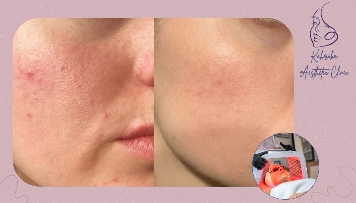 مراقبت‌های بعد از فیشیال پوست‌های چرب