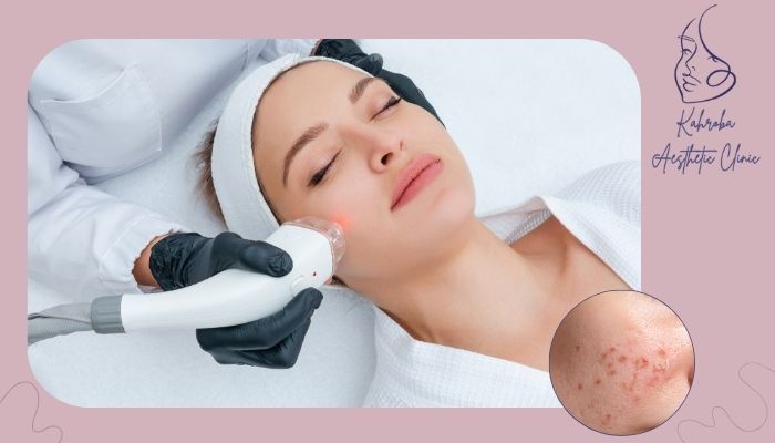 علت جوش زدن بعد از لیزر موهای زائد چیست؟