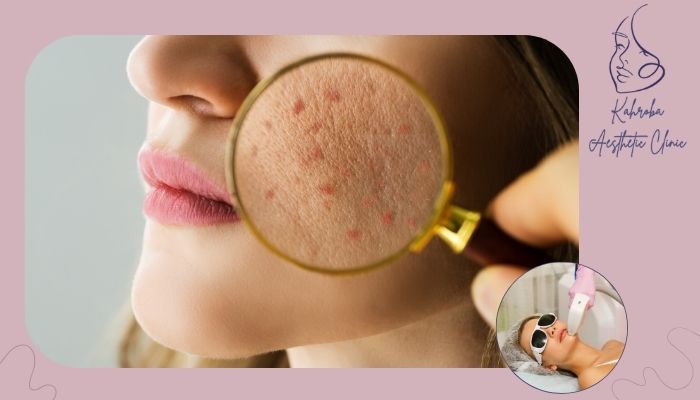 چقدر طول می‌کشد تا جوش‌ها خوب شوند؟