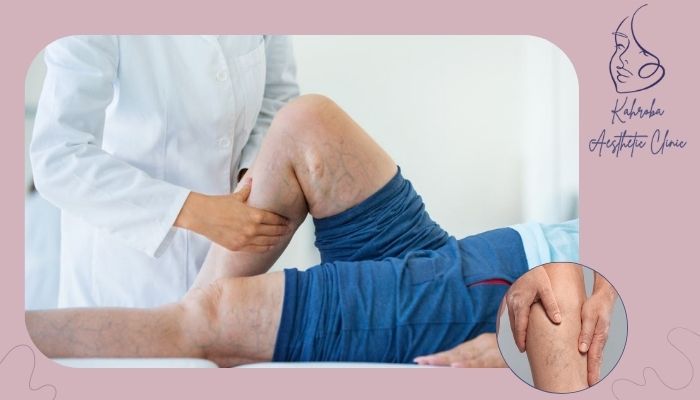 آیا ماساژ برای درمان واریس پا مفید است؟ آیا ماساژ برای درمان واریس پا مفید است؟