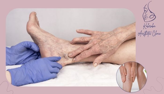 شرایط خطرناک ماساژ برای واریس پا شرایط خطرناک ماساژ برای واریس پا