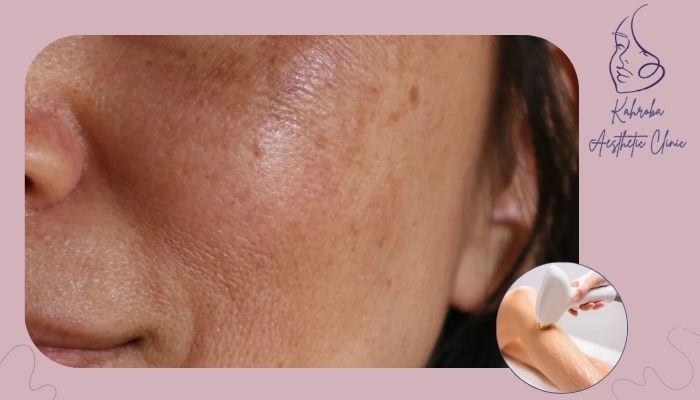 چرا بعد از لیزر پوست دچار لکه‌های قهوه‌ای می‌شود؟