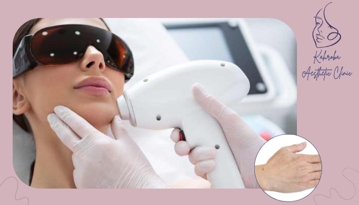 آیا نوع لیزر در بروز لکه‌های قهوه‌ای موثر است؟