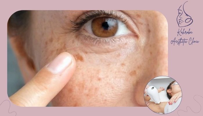 راه‌های درمان لکه قهوه‌ای بعد از لیزر