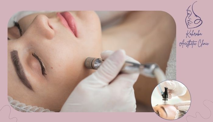 آیا میکرودرم روش مؤثری برای حذف لک است؟ آیا میکرودرم روش مؤثری برای حذف لک است؟