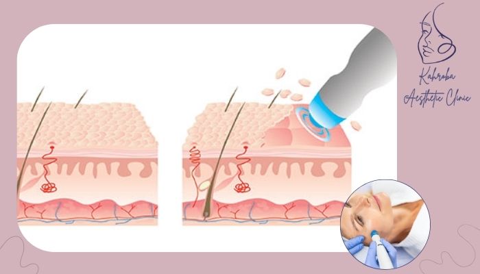 چه زمانی نباید میکرودرم انجام داد؟ چه زمانی نباید میکرودرم انجام داد؟
