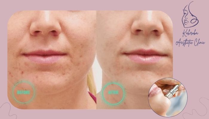 کدام لکهای پوستی با میکرودرم برطرف میشوند؟ کدام لکهای پوستی با میکرودرم برطرف میشوند؟