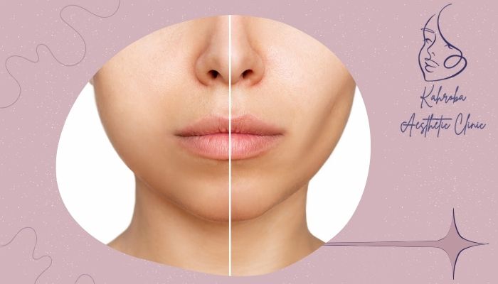 تورم صورت بعد از بوکال فت تا چند روز طبیعی است؟