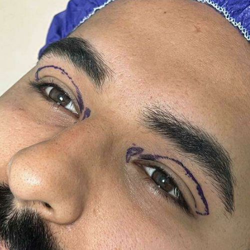 بلفاروپلاستی