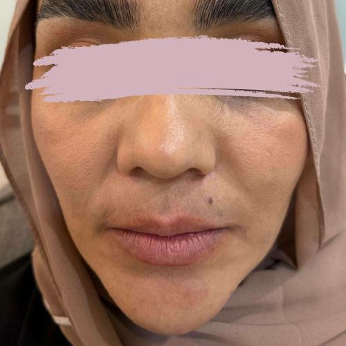 تزریق ژل لب تزریق ژل لب