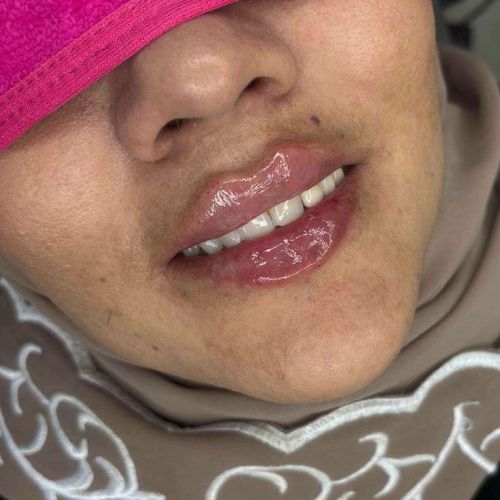 تزریق ژل لب تزریق ژل لب