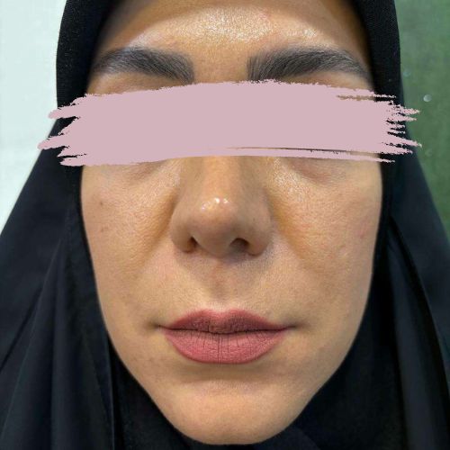 تزریق ژل لب تزریق ژل لب