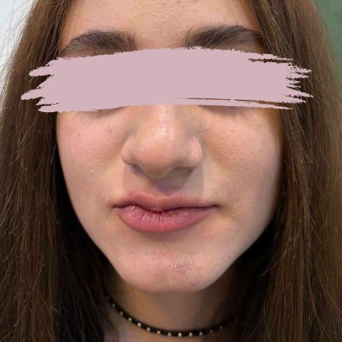 تزریق ژل لب تزریق ژل لب