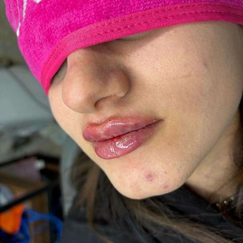 تزریق ژل لب تزریق ژل لب