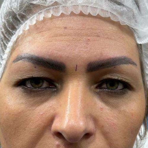 جراحی پلک (بلفاروپلاستی) جراحی پلک (بلفاروپلاستی)