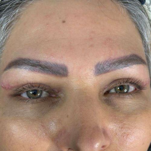 جراحی پلک (بلفاروپلاستی) جراحی پلک (بلفاروپلاستی)