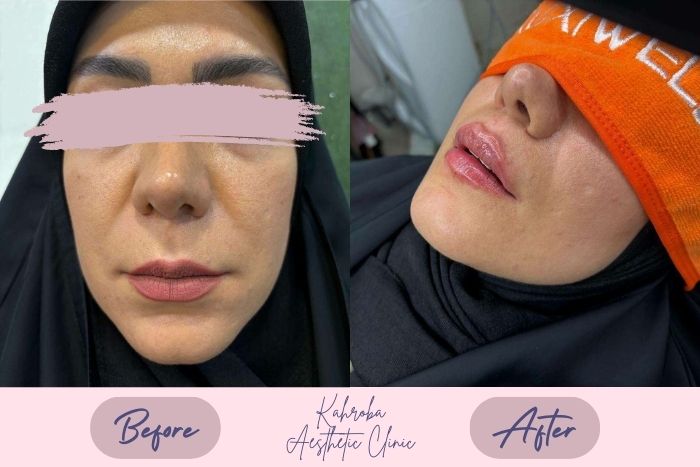 نمونه کار تزریق ژل کهربا