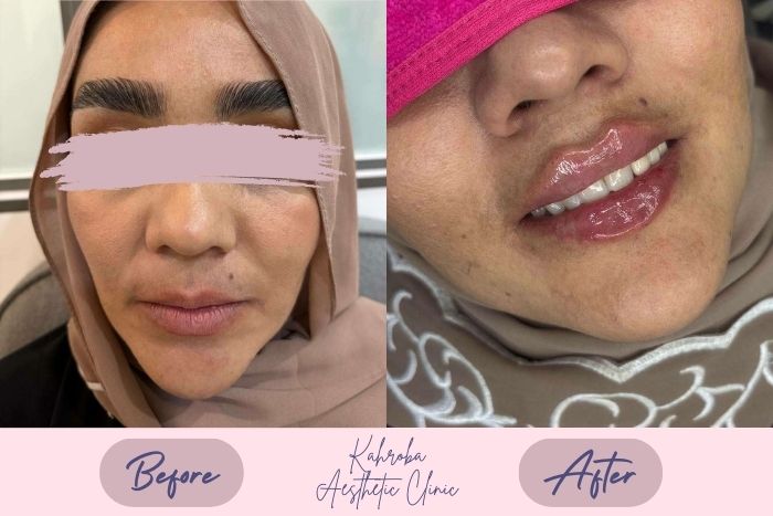 نمونه کار تزریق ژل کهربا