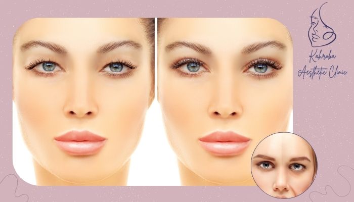 بلفاروپلاستی برای چه کسانی مناسب است؟