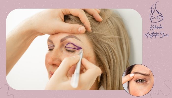 چرا باید بلفاروپلاستی را انتخاب کنید؟