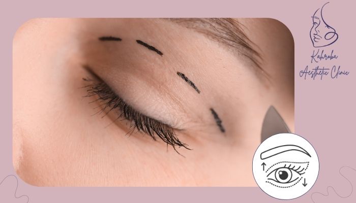 تفاوت بلفارو با روش های غیر جراحی تفاوت بلفارو با روش های غیر جراحی