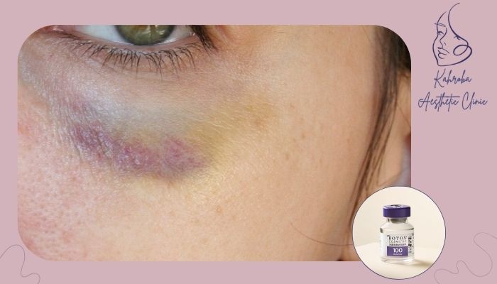 عوامل موثر بر شدت کبودی عوامل موثر بر شدت کبودی