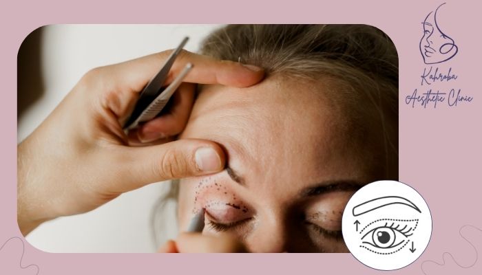 ماندگاری عمل در افتادگی خفیف ماندگاری عمل در افتادگی خفیف