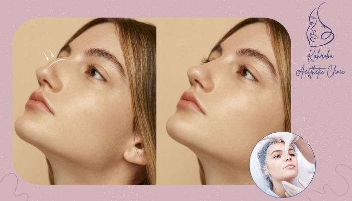 مراقبت‌های ضروری پس از تزریق فیلر بینی