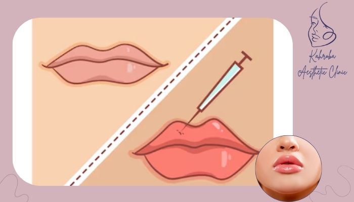 نشانه های واضح نیاز به ترمیم فیلر 