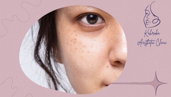 چرا بعضی افراد بعد از لیزر دچار لکه‌های قهوه‌ای روی پوست می‌شوند؟