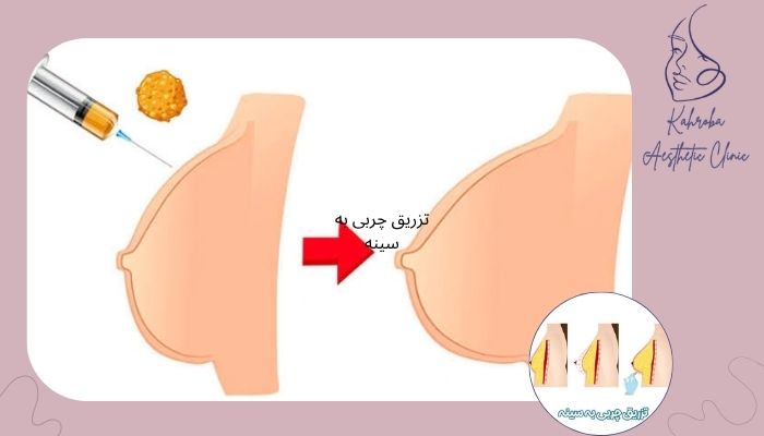 تزریق چربی به سینه چه خطراتی دارد؟ تزریق چربی به سینه چه خطراتی دارد؟